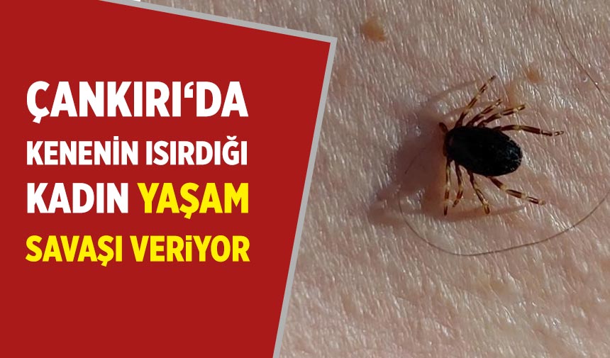 Çankırı ‘da kenenin ısırıdığı kadın yaşam savaşı veriyor